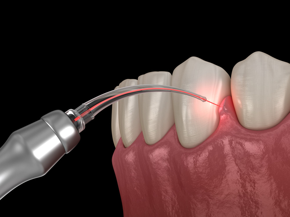 The-Versatility-of-Lasers-in-Cosmetic-Dentistry