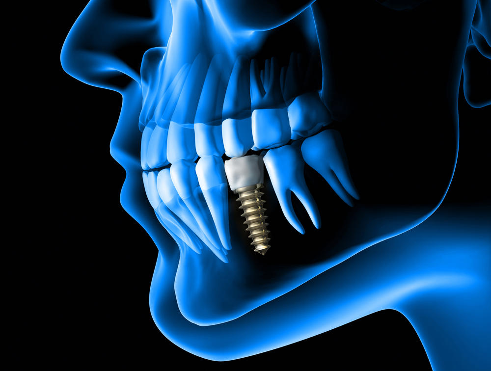 Dental Implant (What Can You Expect with a Dental Implant Treatment)