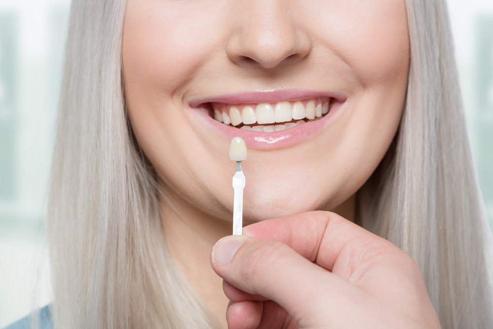 Lady Smiling - How Can Dental Veneers Improve Your Smile