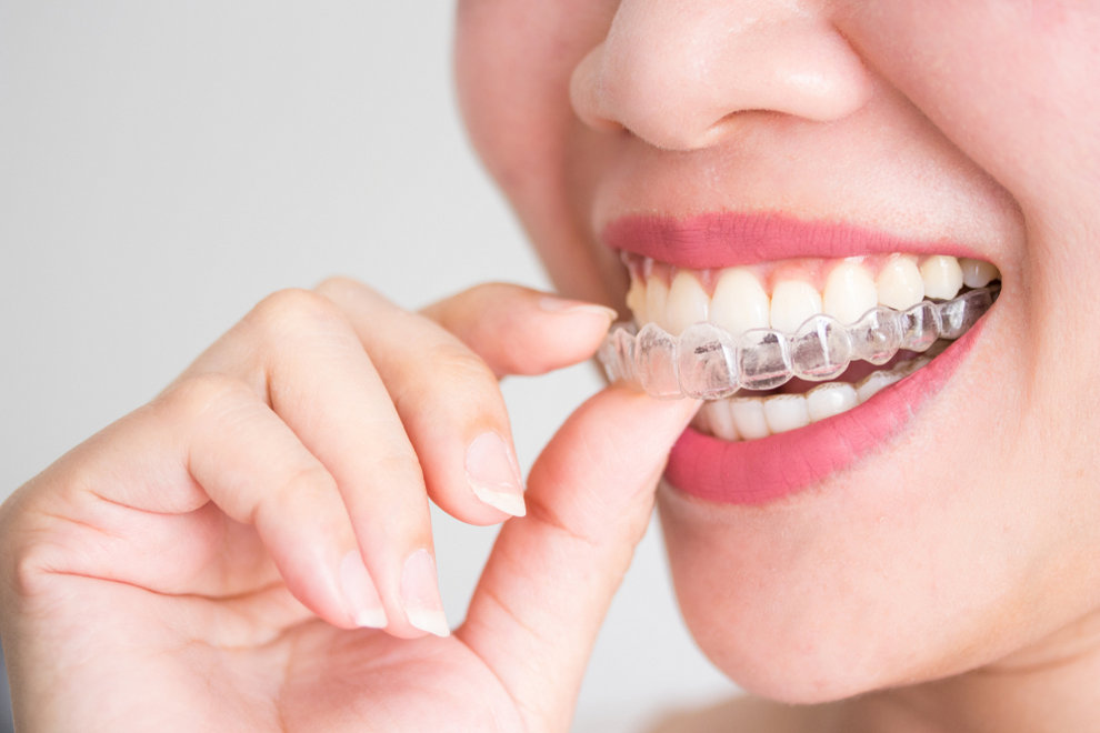 11 Quick Facts About Invisalign