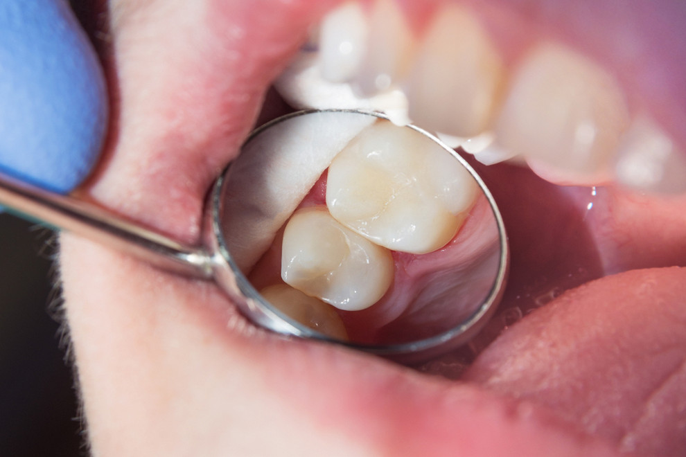 The Benefits Composite Resin Have Over Amalgam Fillings