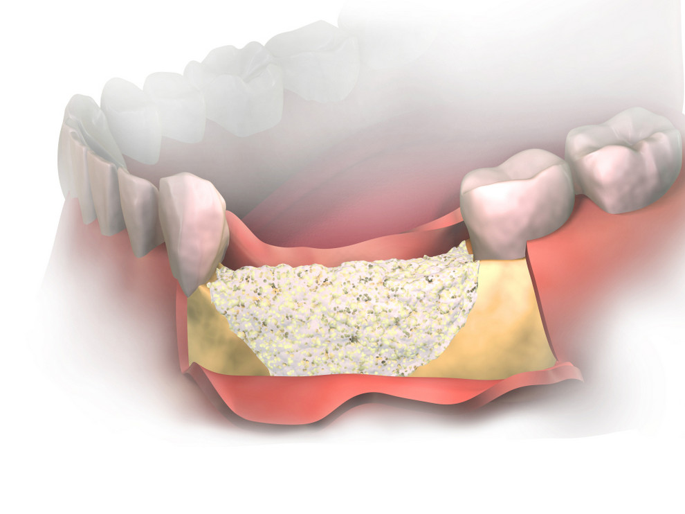 What is Bone Grafting