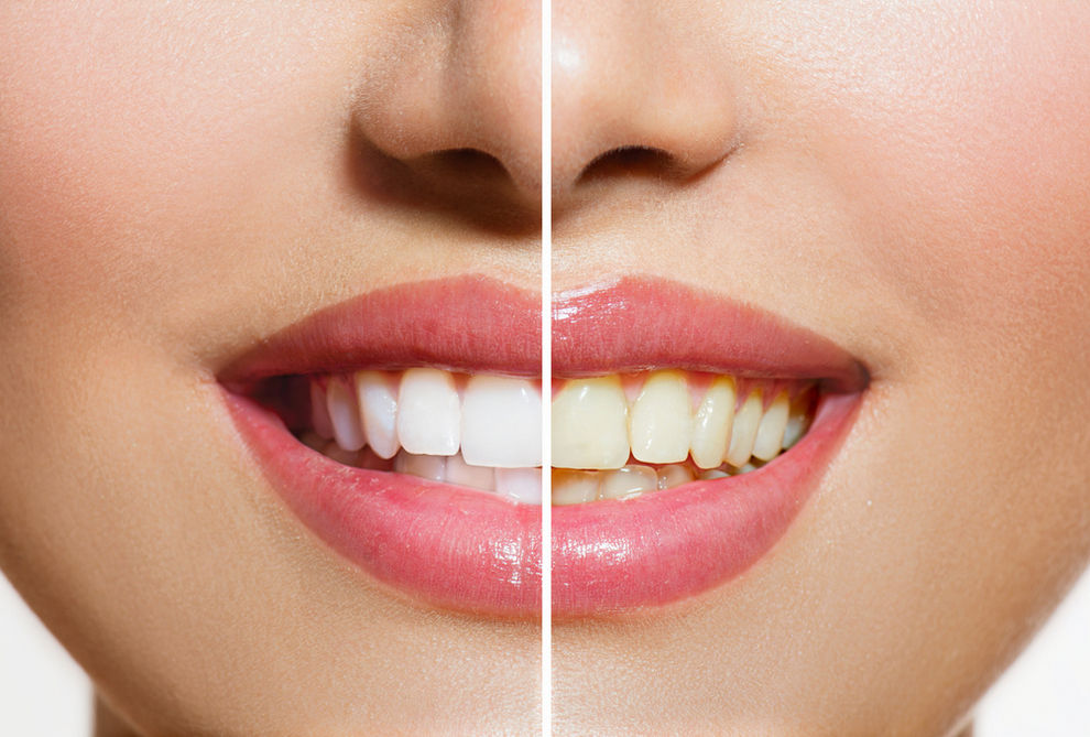 Zoom Teeth Whitening